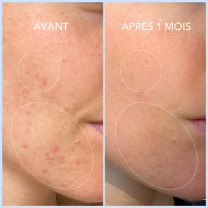 ACNÉ HORMONALE