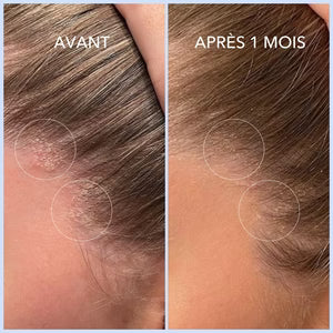 PSORIASIS